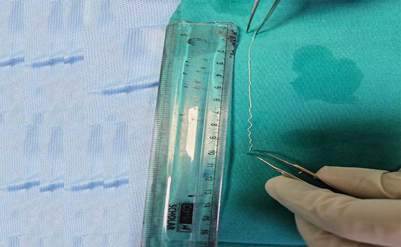 പത്തു സെന്റിമീറ്റര്‍ നീളമുള്ള വിരയെ യുവതിയുടെ കണ്ണിൽ നിന്ന് പുറത്തെടുത്ത് കിംസ്ഹെൽത്ത്